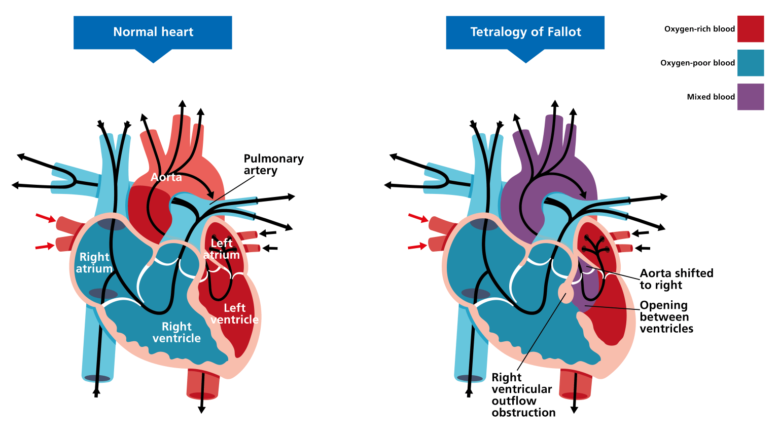 Tetralogy of Fallot NCP Writing Services