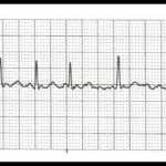 Cardiac Case Study Assignment Help