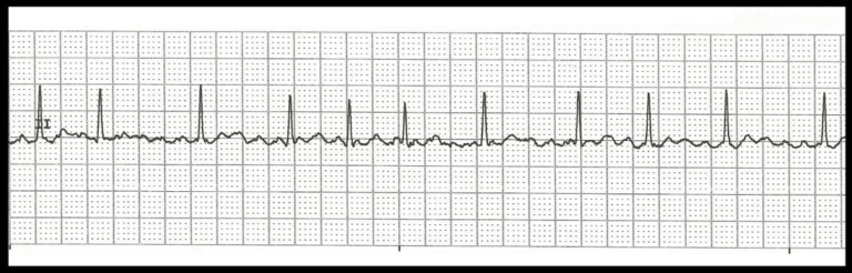 Cardiac Case Study Assignment Help