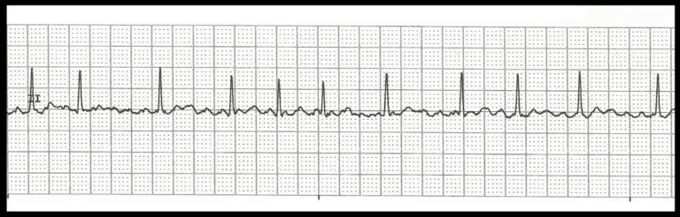 Cardiac Case Study Assignment Help