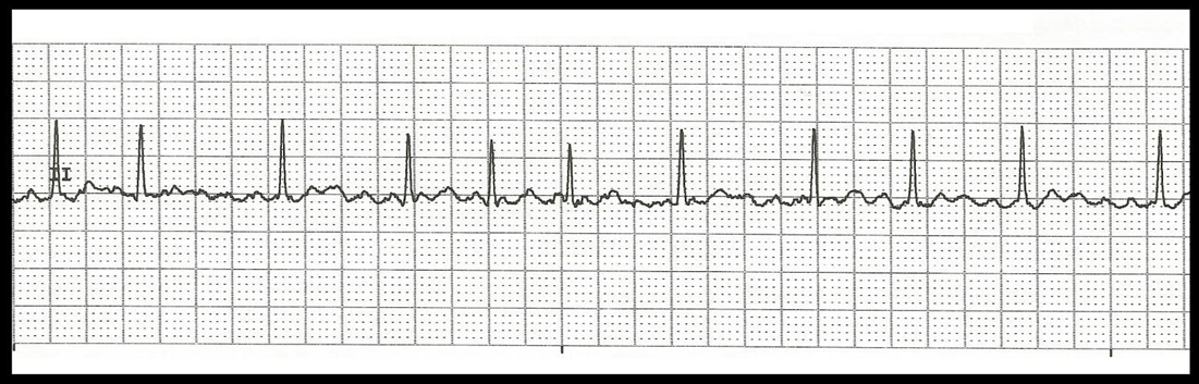 Cardiac Case Study Assignment Help